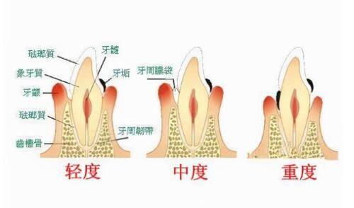 三、严格遵循术后护理细节，加速修复进程