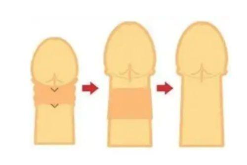 三、疤痕体质不能参军的核心原因