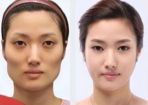 二、凹陷性鼻子疤痕的针对性消除方案