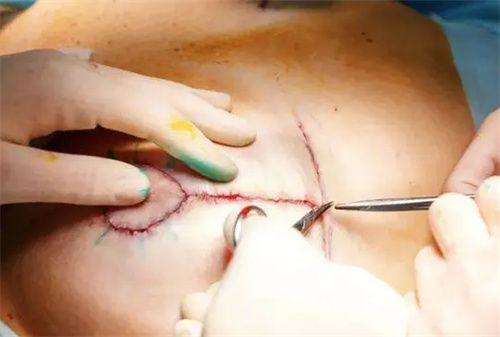 五、临时遮盖方法，快速改善外观应急方案