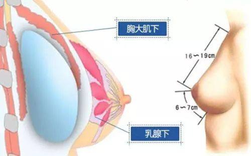 四、特殊兵种对疤痕体质的限制更为严格