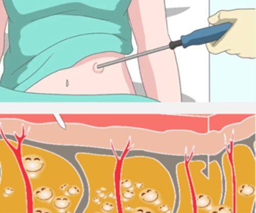 三、激光及光电联合疗法：适配各类型手术疤痕