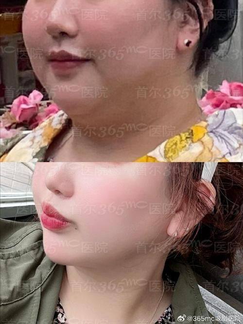 南京恒丽整形医院价格表：