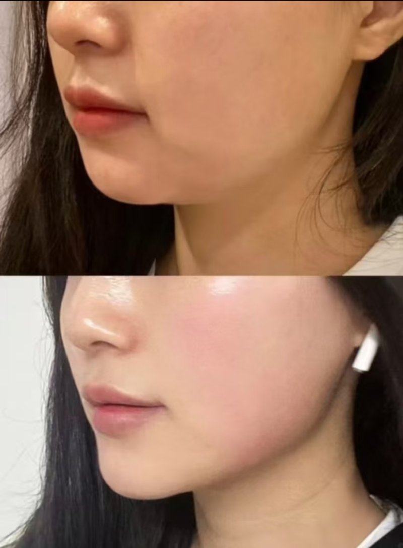 三、疤痕性皮肤治疗的日常护理与风险管控