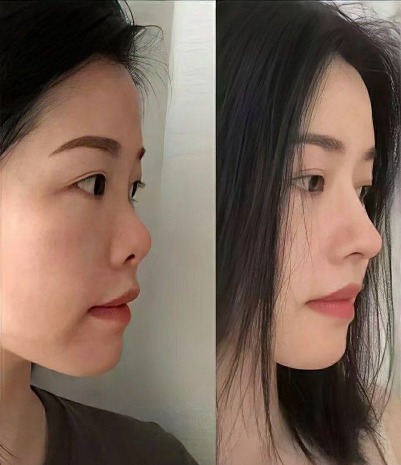 五、鼻子疤痕消除的费用参考