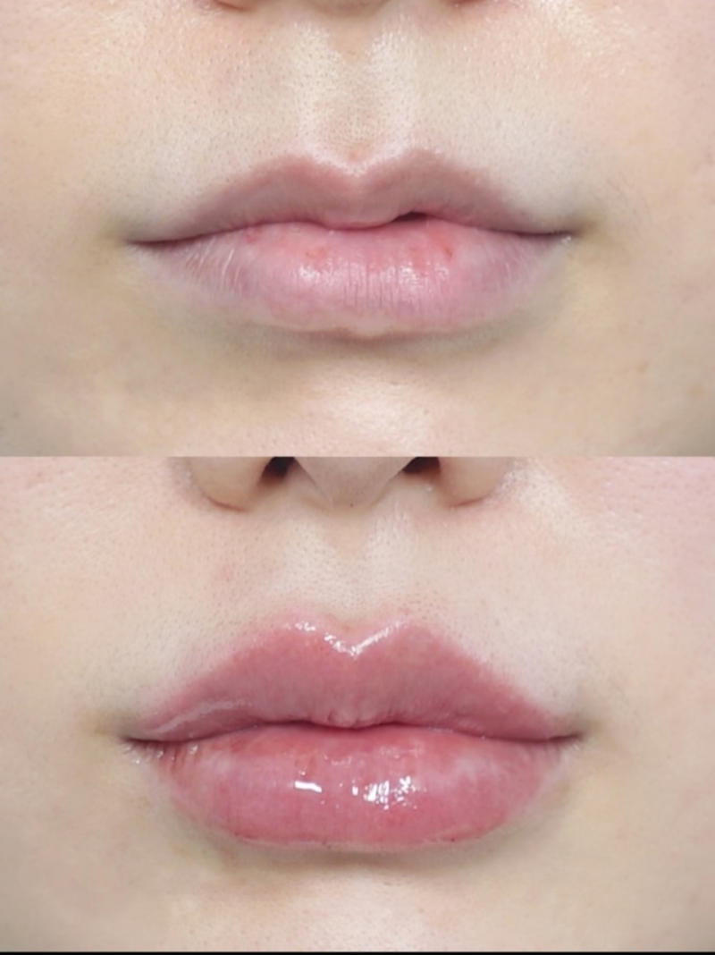 五、儿童脸上疤痕：安心优先的个性化修复策略