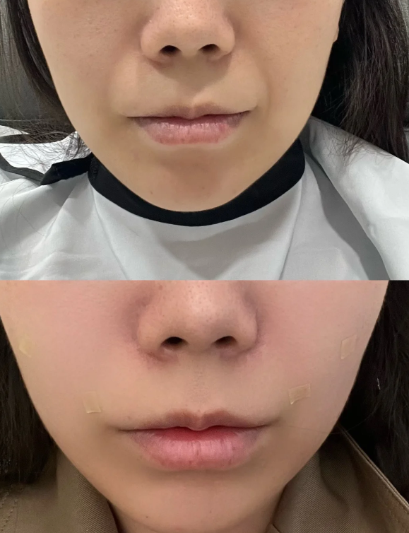 五、其他辅助疗法：复杂疤痕的个性化选择