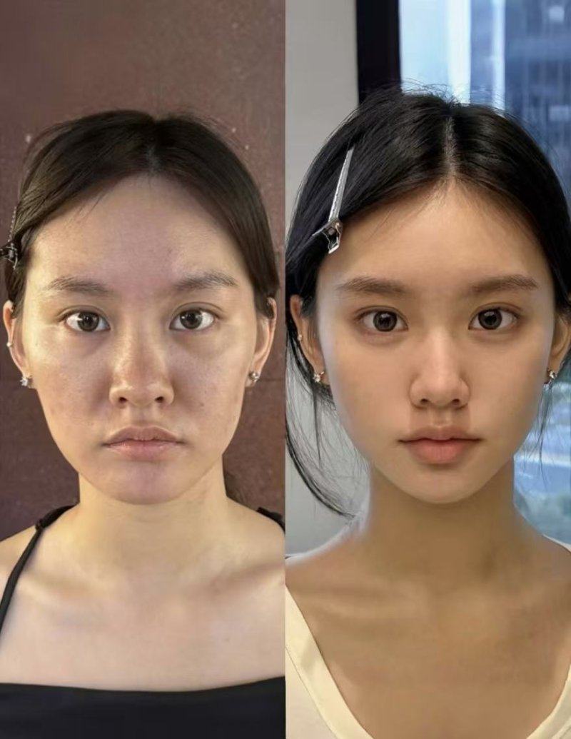 三、增生性疤痕/疤痕疙瘩的消除方案