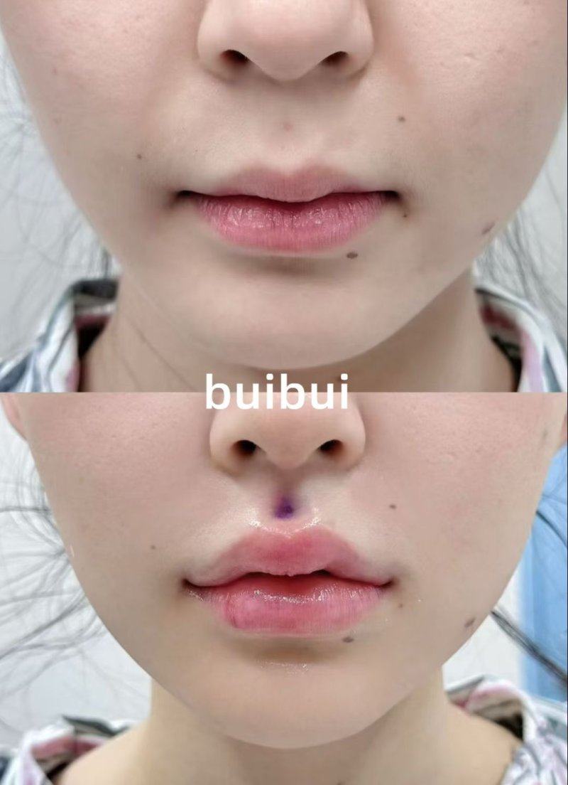 四、色素沉着型旧疤、轻度增生小疤的改善方案