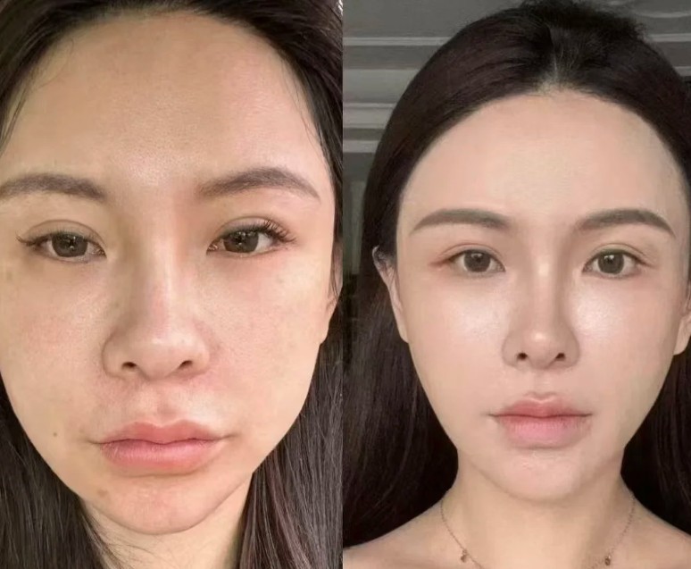 四、鼻部术后疤痕的修复方案