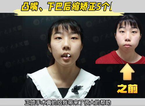 三、仅皮肤松弛无咬肌肥大：瘦脸针完全不适用