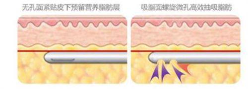 四、激光与手术：硬核改善顽固疤痕凸起