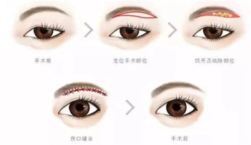 二、从源头降低缝线疤痕风险：选对个性化缝合方案