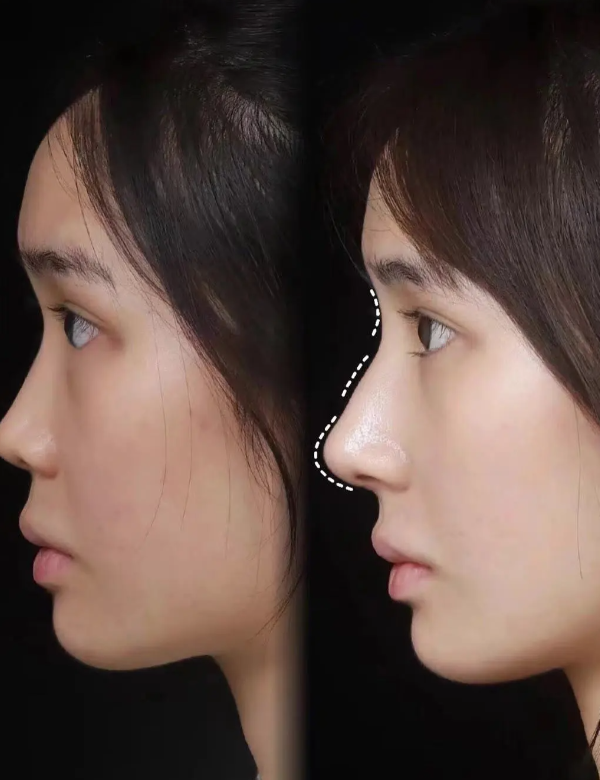 五、双眼皮吊顶的关键注意事项,避坑才能更美观