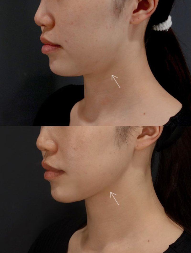 四、先搞懂：瘦脸针的核心适配人群到底是谁