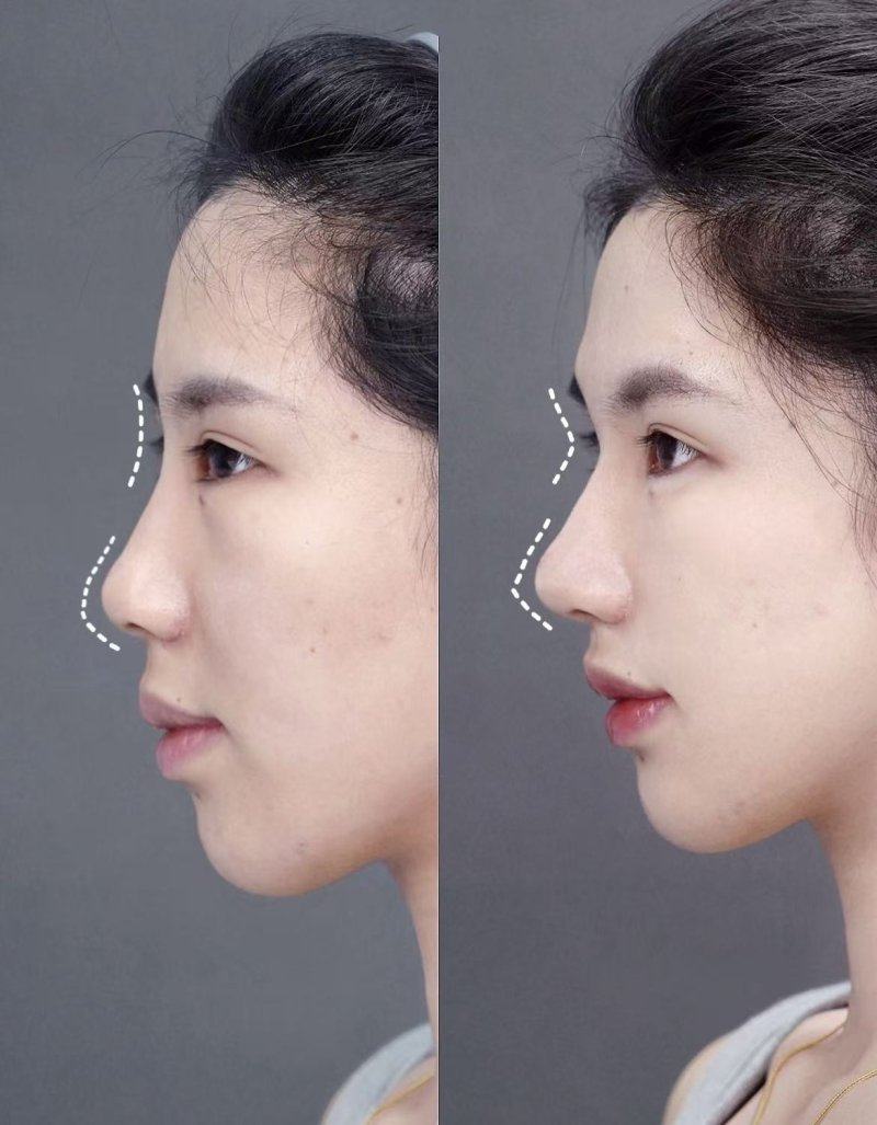 二、小阴唇缩小手术的术后成效