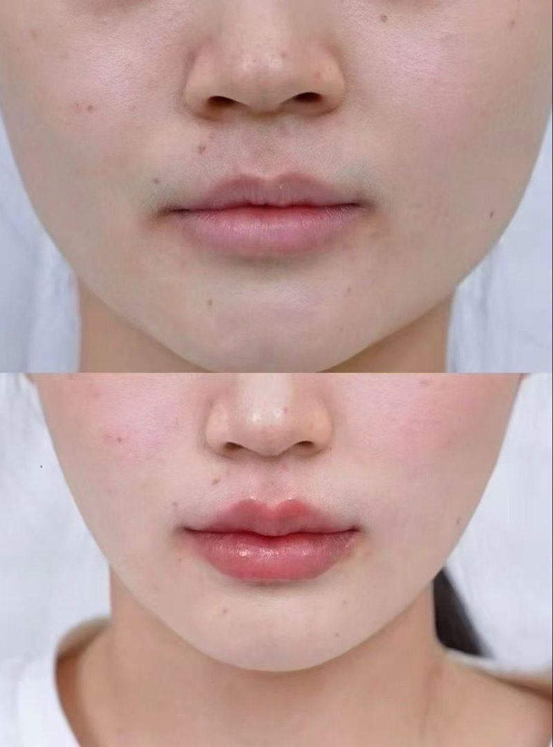 二、国内假体隆胸的住院时长差异