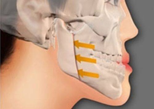 四、术后这些注意事项，关乎隆鼻成效的“保质期”