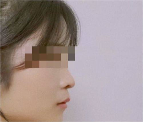 五、疤痕体质做眼袋手术前的关键注意事项