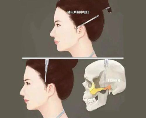 二、疤痕体质能做外切去眼袋手术吗