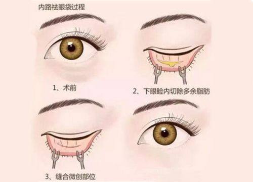 二、全切双眼皮的分阶段修复细节
