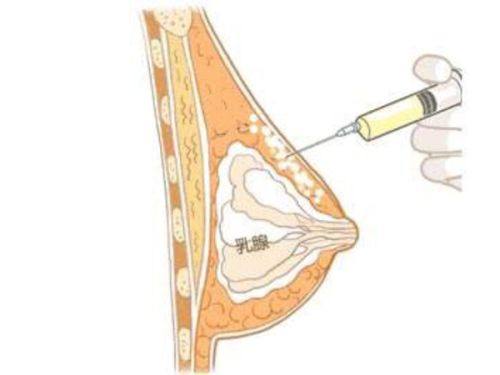 六、疤痕体质做眼袋手术的常见误区纠正
