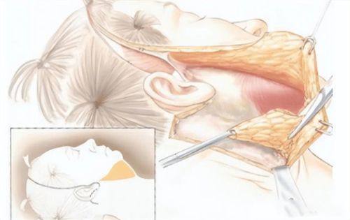 五、去眼袋手术常见误区与注意事项