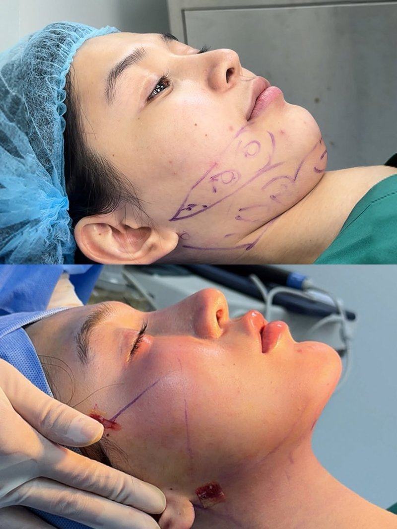 五、拉皮/颅骨填充等大型术后疤痕色素:防晒是关键,已形成色素难自然消退