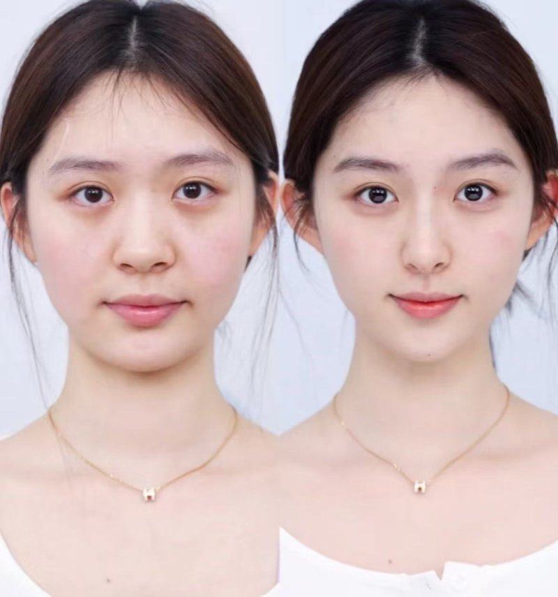 三、疤痕体质做眼袋手术的核心原则