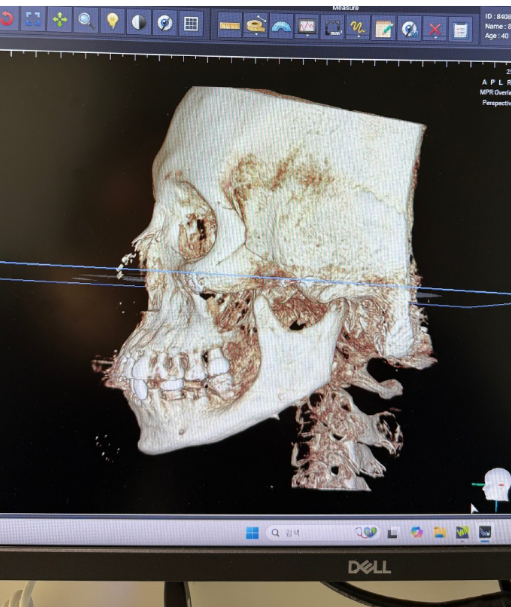三、如何维护才能延长软耳骨隆鼻的成效