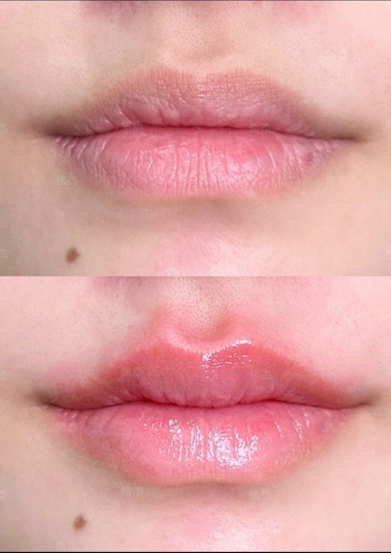 六、色素疤痕的专精干预:精细方案比自然消退成效更理想