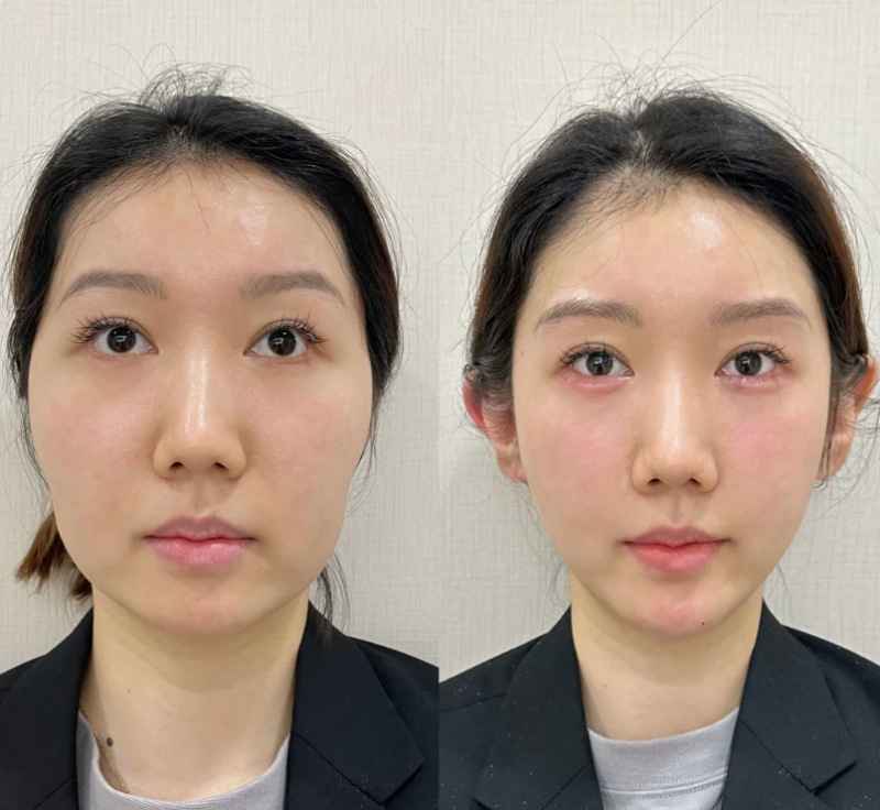 四、双眼皮疤痕增生用什么药膏