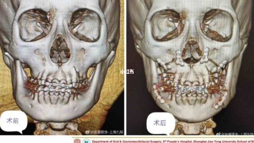 五、如何延缓眼袋的出现时间？针对性预防建议