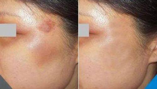 三、成效与速度对比：埋线温和长效控重，吸脂直接精细塑形