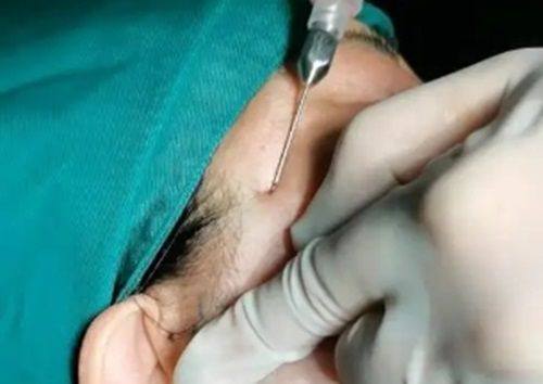 五、不同手术方式对睡眠姿势的要求