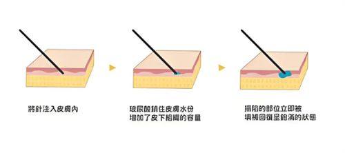 四、怎么快速消除眼袋的小窍门