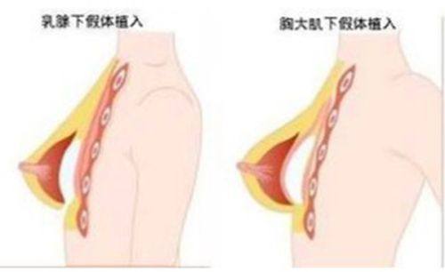 三、激光去眼袋：兼顾改善肤质的轻医美选择