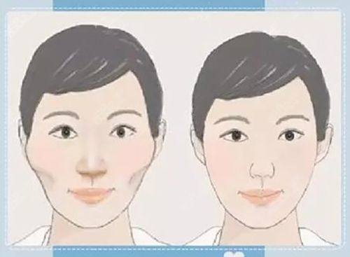 四、假性眼袋和真性眼袋的时间区别：如何判断？