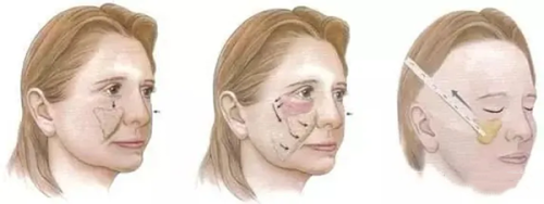 三、哪些诱因会让眼袋提前出现？早发眼袋的背后原因