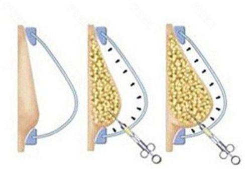 二、不同凹陷疤痕的针对性修复小妙招