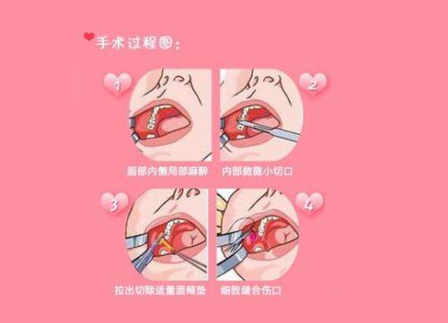 三、长期/近乎恒久维持隆鼻材料：理想状态下的持久选择