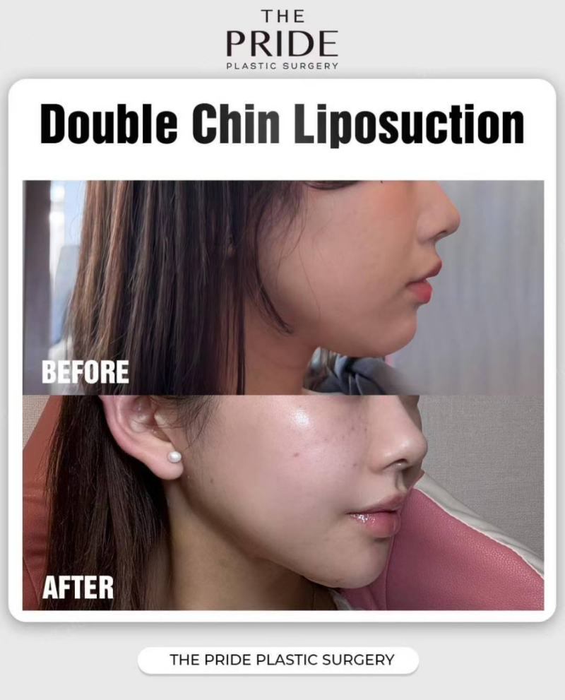 四、创伤与修复期：埋线微创不误工，吸脂有创需遵医嘱修复