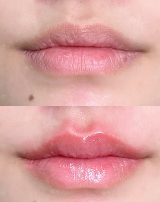 二、中短期维持隆鼻材料：时效有限，各有侧重