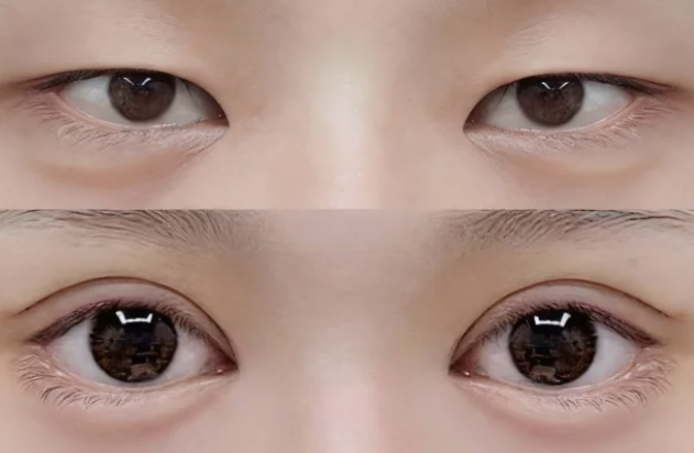 二、怎么样能快速消除眼袋和黑眼圈