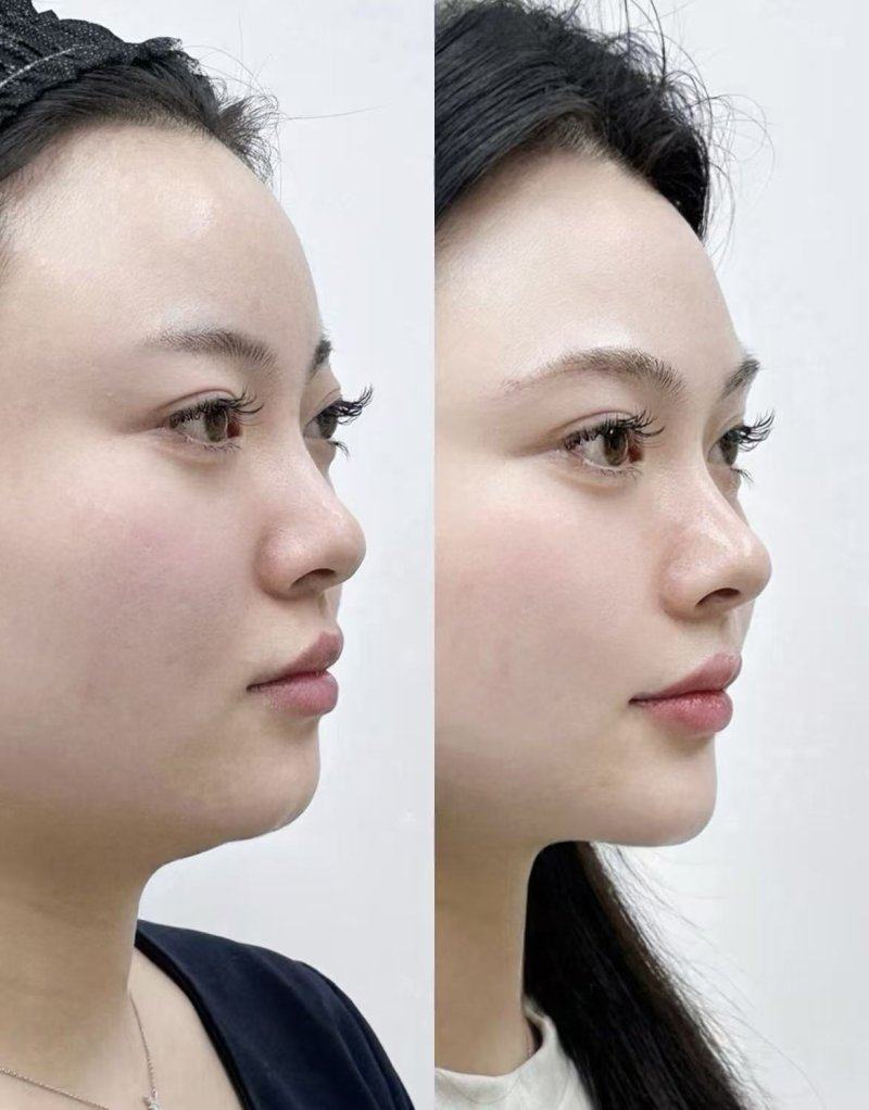 三、女性群体需重点关注的抽脂后遗症