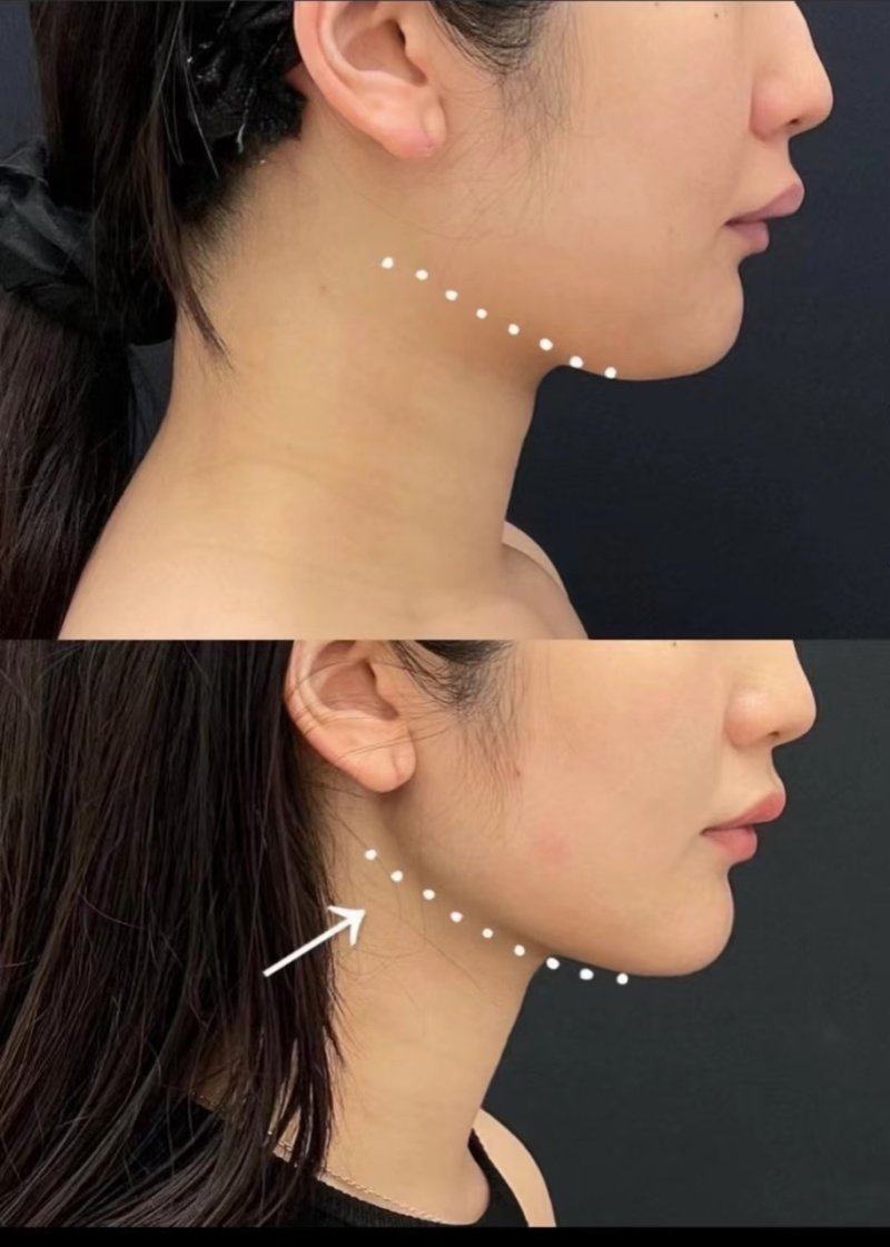 五、外切去眼袋：解决中老年松弛型眼袋的有效方案