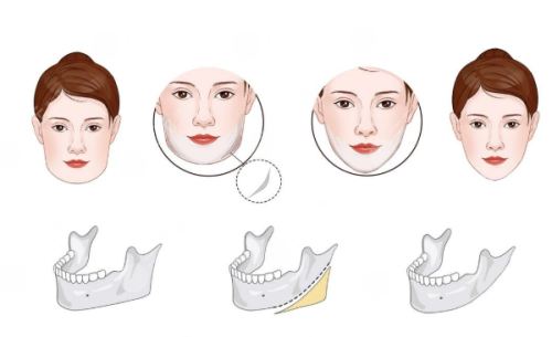 一、术后早期:科学护理,给疤痕“自愈期”保驾护航