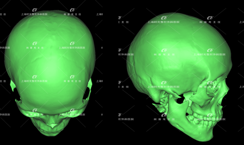 二、增生性烫伤疤痕：分程度选修复方案