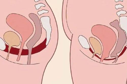 四、不同术式的纳米双眼皮维持时间差异