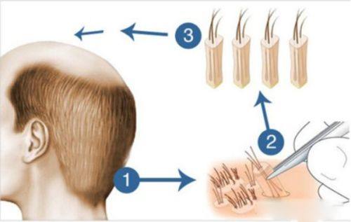二、疤痕增生能治疗吗？不同类型对应干预方案